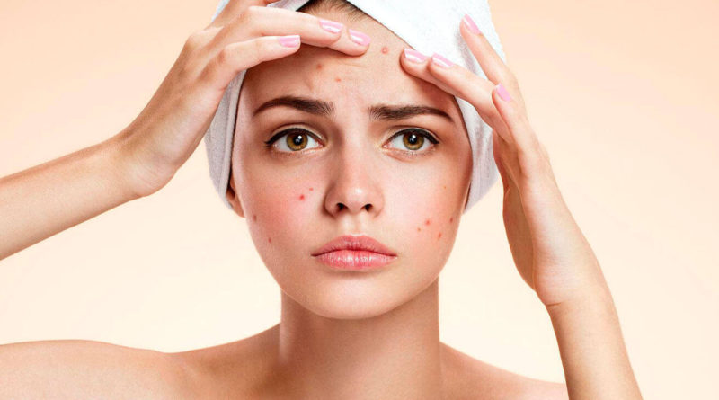 Лучшие средства от прыщей Лучшие средства от прыщей